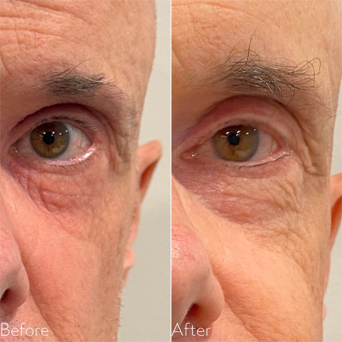 Before and after Forma RF showing firmer skin under the eye