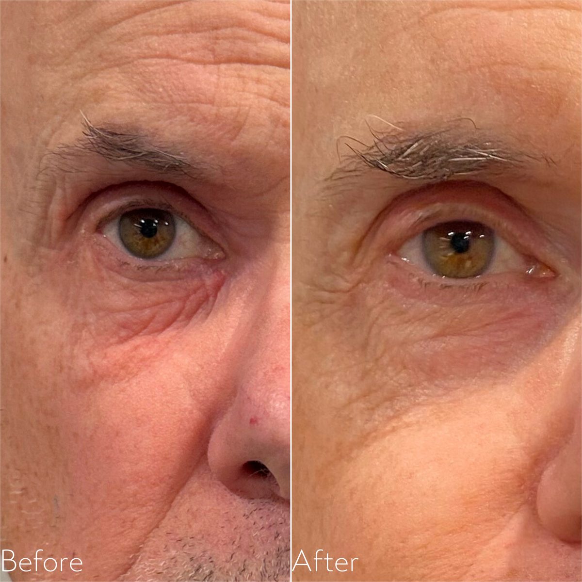 Before and after Forma RF showing firmer skin under the eye and across the cheek
