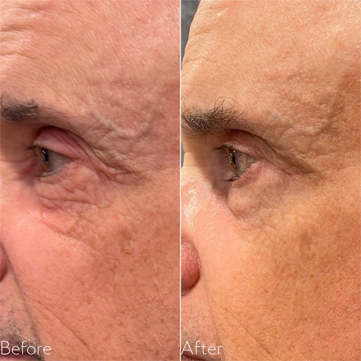 Before and after Forma RF showing softened crepe skin around the eye