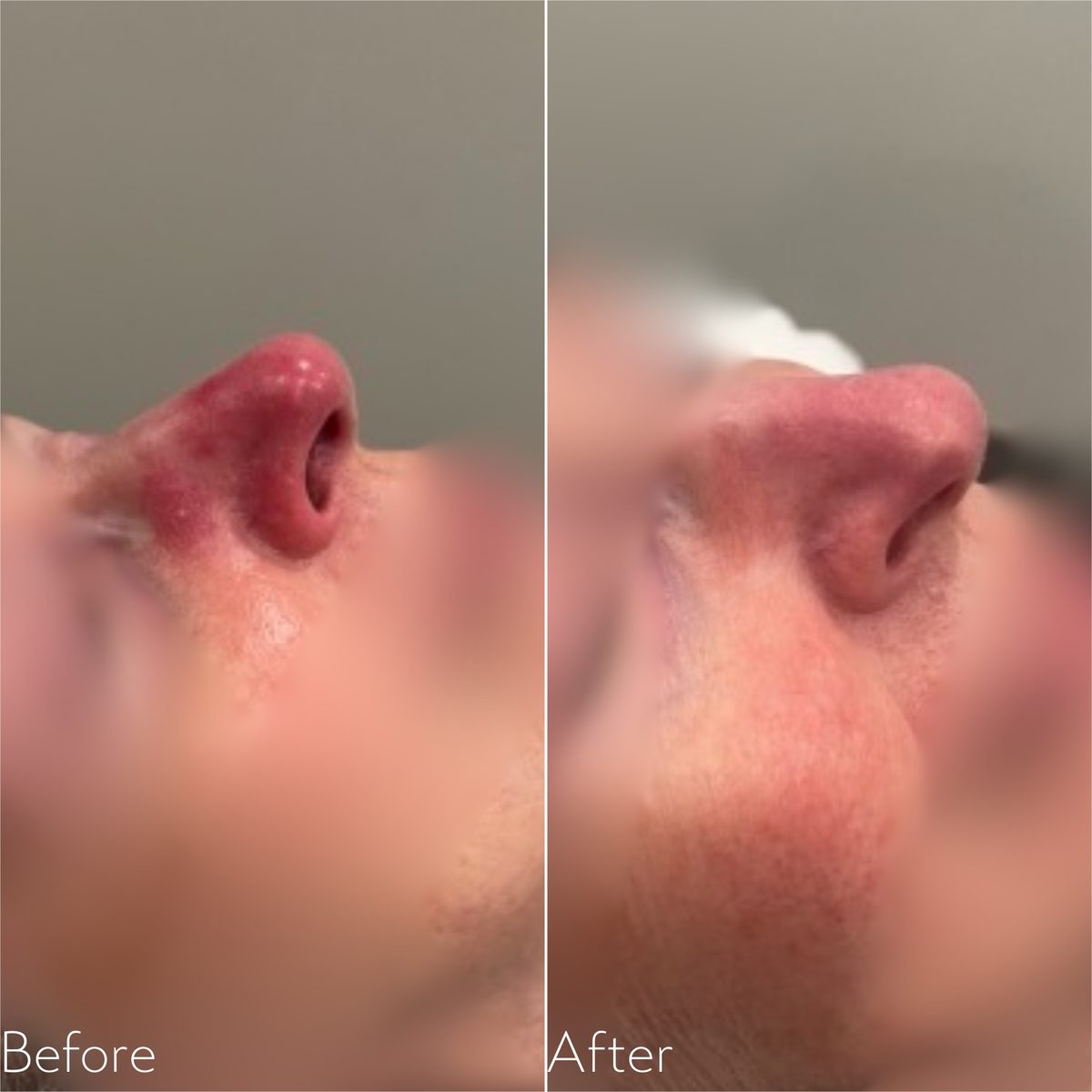 Before and after Lumecca IPL for facial redness across the nose and cheek