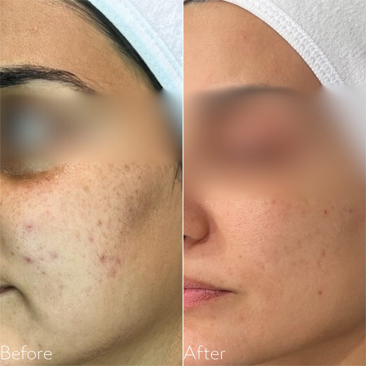 Before and after Lumecca IPL for post-acne marks and uneven pigment on the cheek