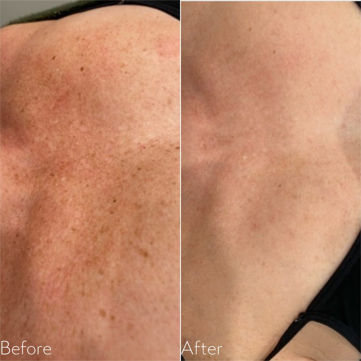 Before and after Lumecca IPL for sun damage on the chest and d&eacute;collet&eacute;