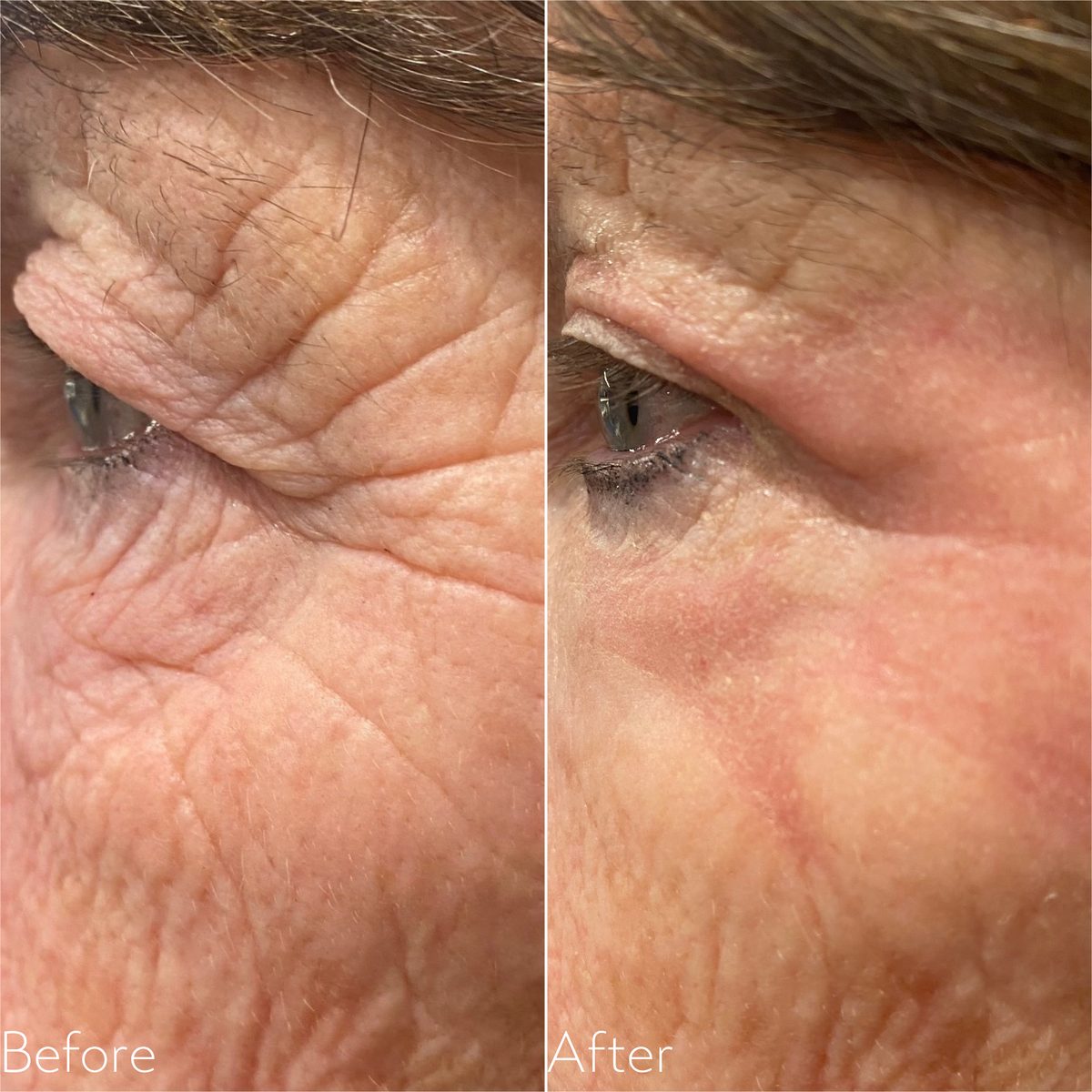 Before and after Plexr Plus on the left upper and lower eyelid