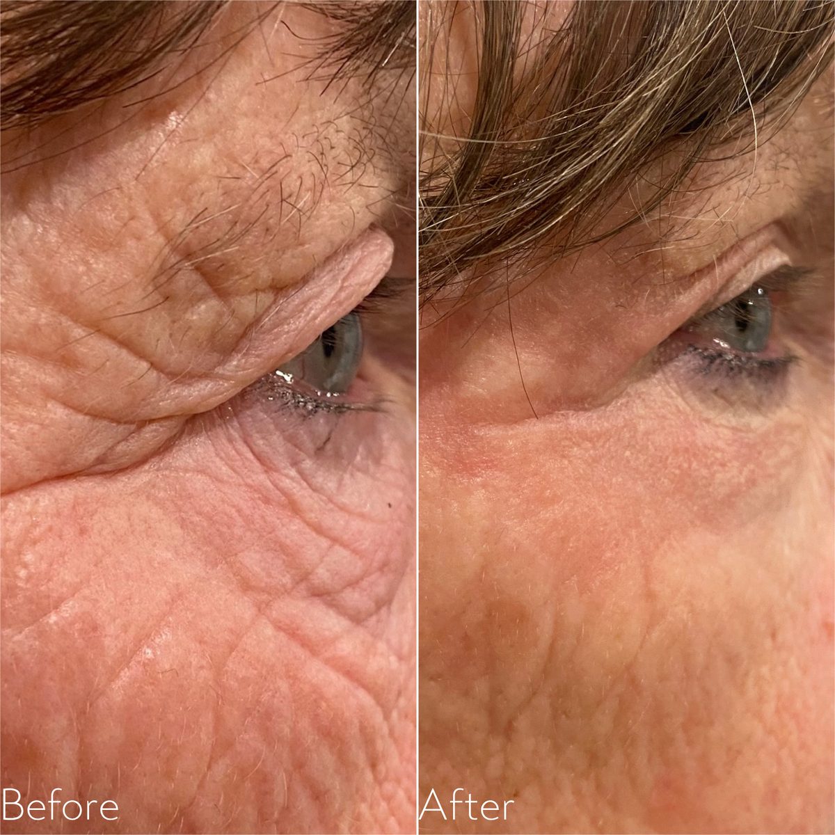 Before and after Plexr Plus on the right upper and lower eyelid