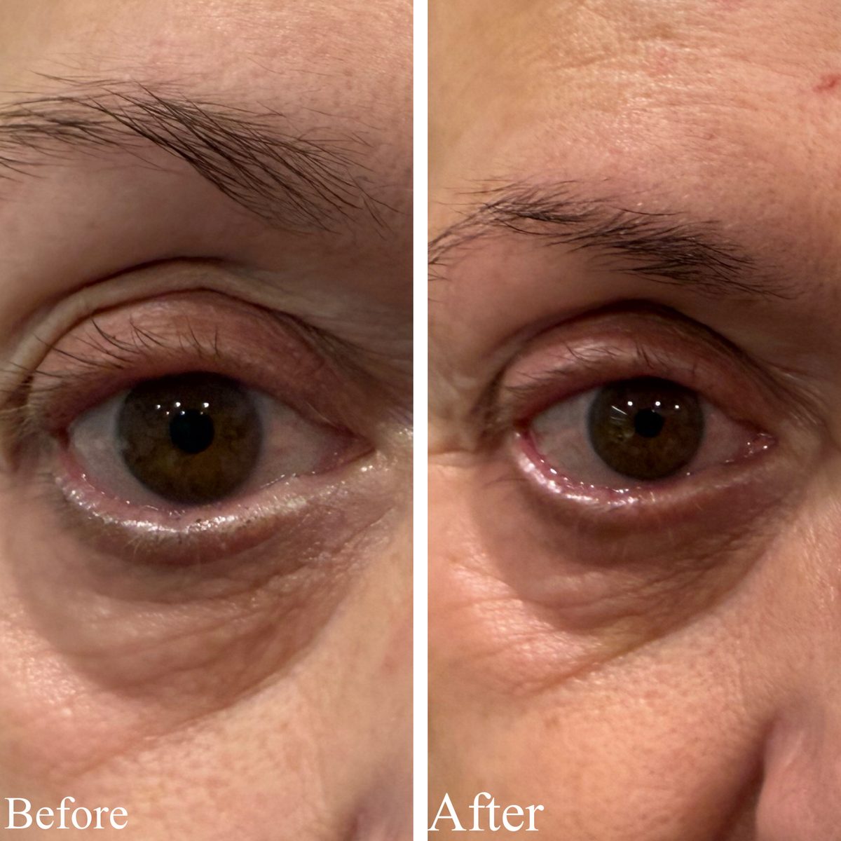 Before and after Plexr Plus showing tightened eyelid skin