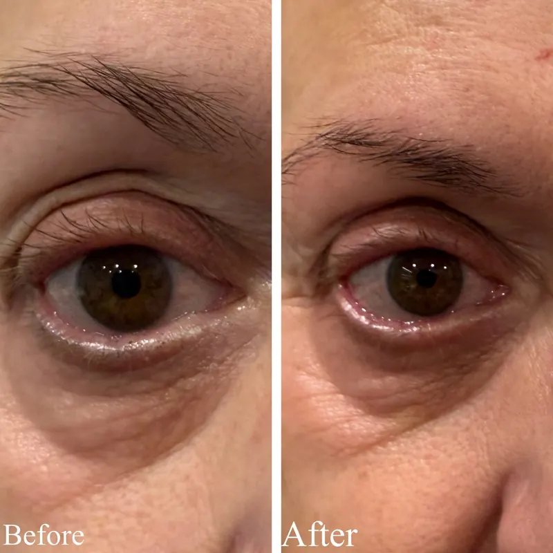 Before and after Plexr Plus showing tightened eyelid skin