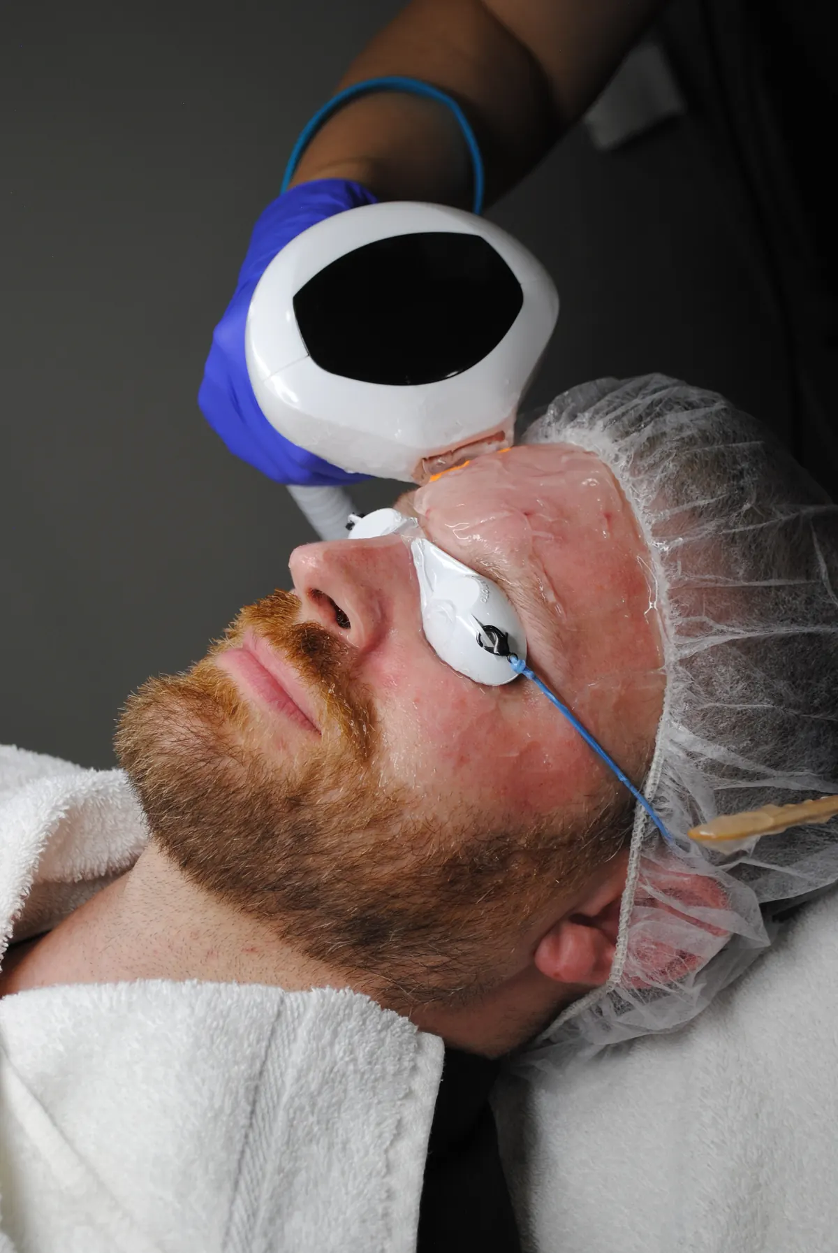 A Lumecca IPL treatment, with protective eye shields in place