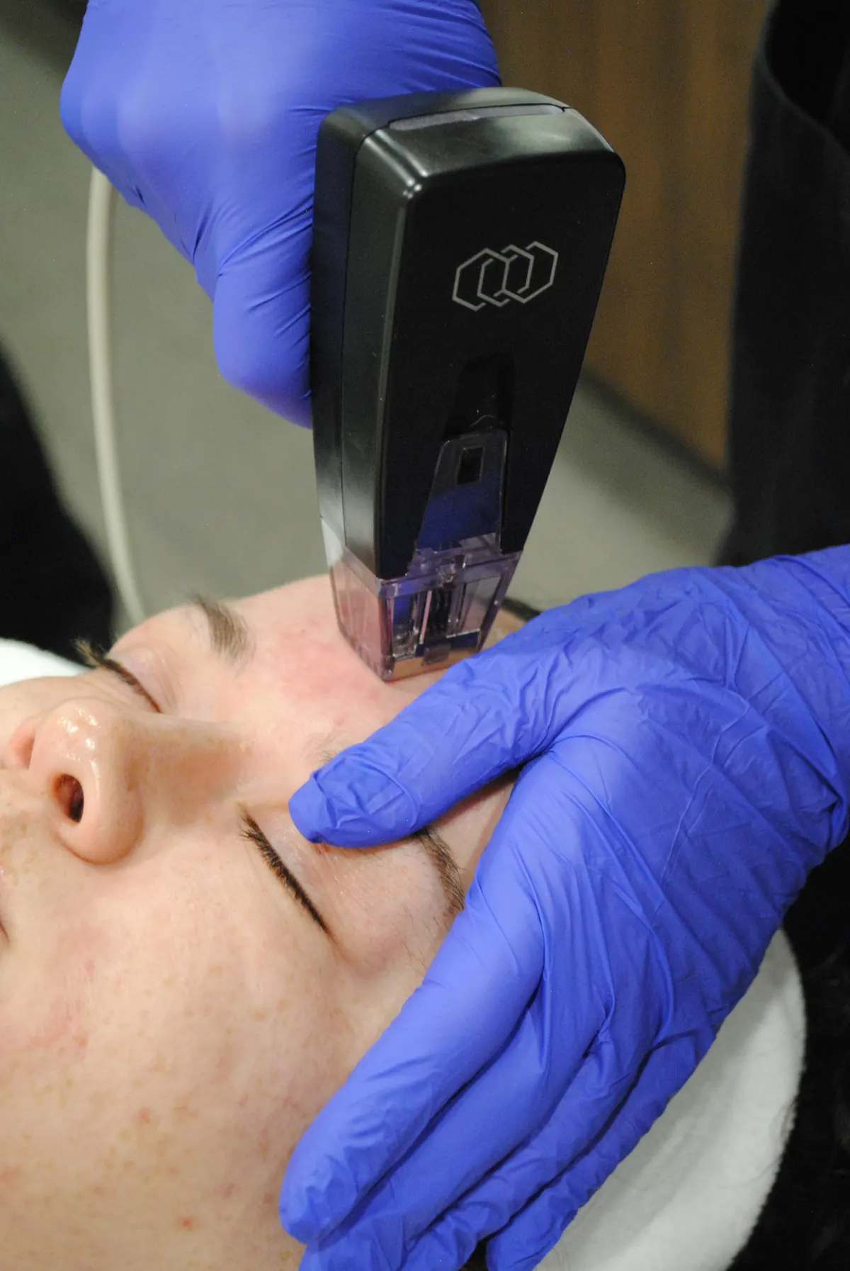 The Morpheus8 handpiece being applied along the jawline